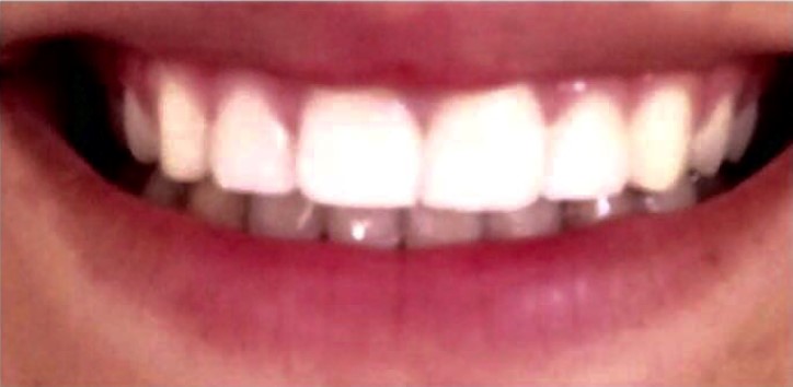 רפואת שיניים אסתטית-אחרי