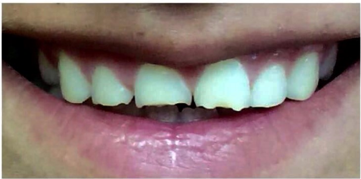 רפואת שיניים אסתטית-לפני