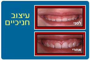 עיצוב החניכיים